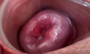 Small cervix without dilating
